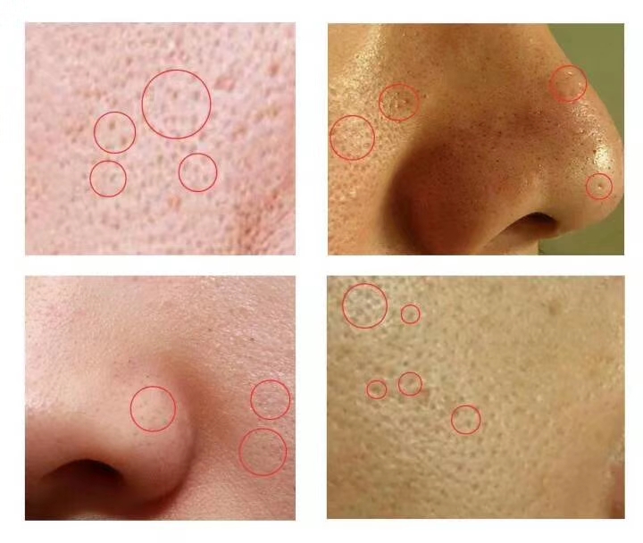 blaekhead,pores,acne blaekhead,pores,acne